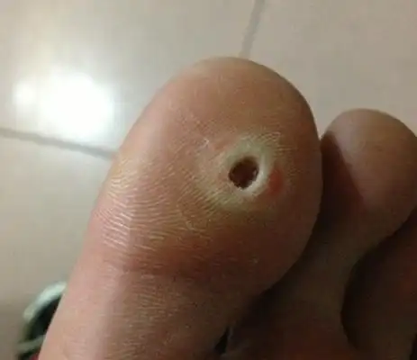 脚鸡眼图片 (3)_有来医生