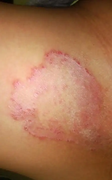 这个什么皮肤病,总是很痒,然后就要去抓它,抓到破皮.