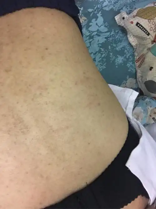 女生后背长痘痘有痘印怎么回事怎么办