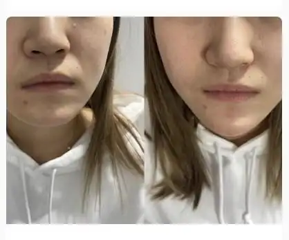 破尿酸填充下巴对比