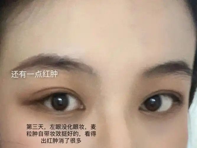 总结———-眼睛发炎:红霉素眼膏搭配左氧氟沙星滴眼液麦粒肿