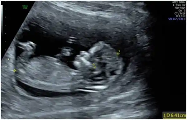 一口气教您读懂超声nt报告_胎儿_筛查_检查