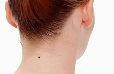 脖子上痣相图解大全(女人脖子上痣相图解大全)