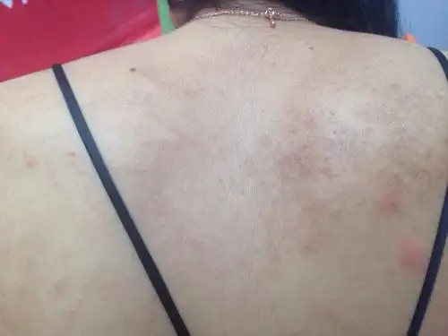 三九皮炎平?在线等医生!谢谢! 请问医生我后背的这个算是什么?