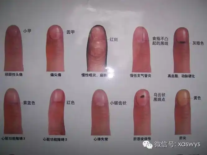 通过望手指甲就能诊断出疾病-指甲诊病法