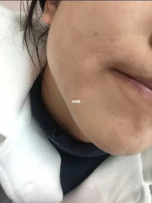 太干了 皮肤 角质层太薄 一到换季起皮严重