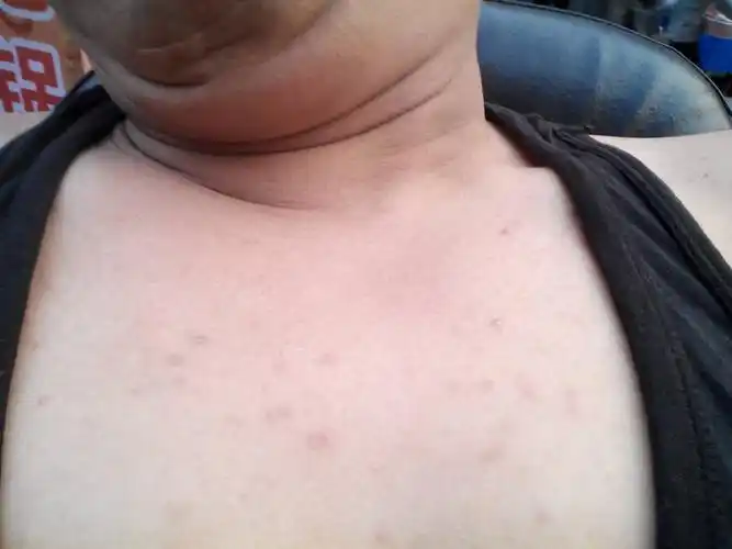 起了很多豆豆怎么回事,只有胸脯上有