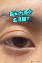 用眼太多,身体虚弱,眼神经麻痹或者重症肌无力
