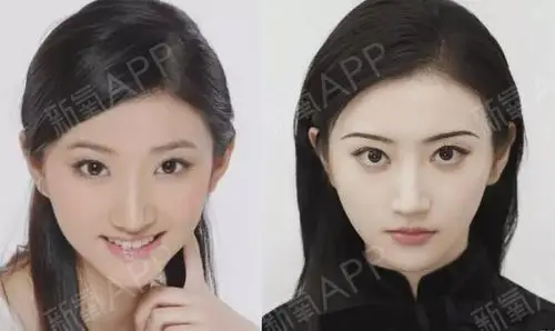 所以,双眼皮绝对不是越宽越好,要符合个人气质和面