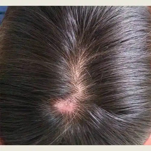 去除头皮屑用什么洗发水好