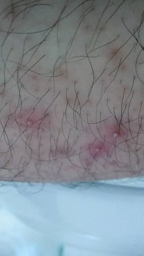 大腿上长这种痘痘,怎么办