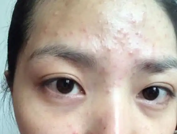 痘痘的出现都是你自己的原因,想要彻底祛痘,你需要做到这些|痘痘|肌肤