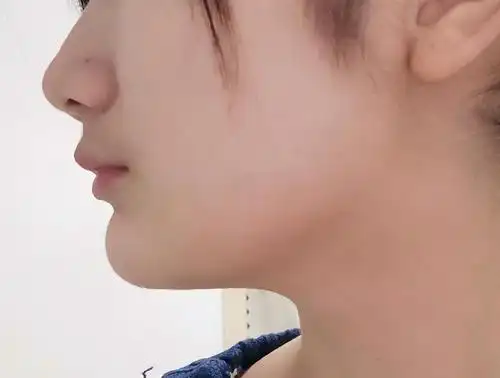 求助笑起来我的下巴真的好奇怪啊