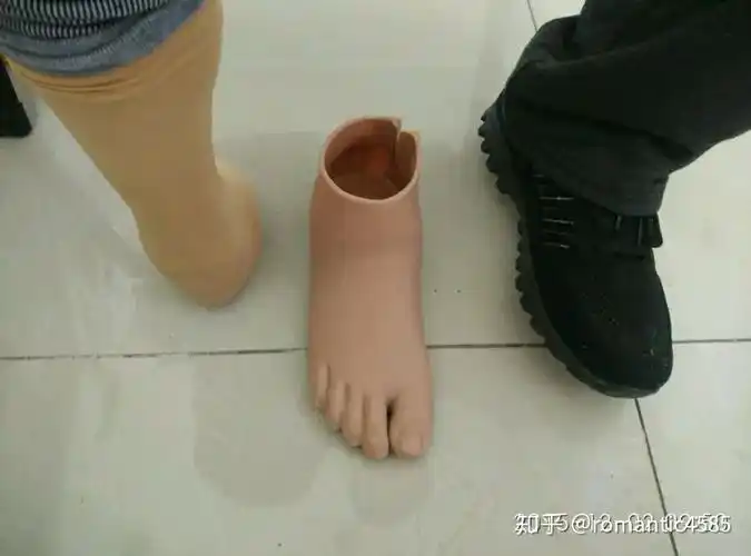 半足截肢患者选择假肢标准介绍(知乎版) - 知乎