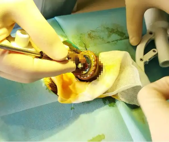 包皮环切术吻合器精解