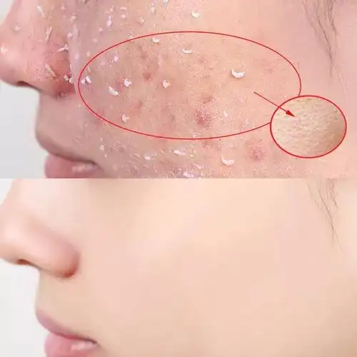 美白去死皮素_去角质面部男女士美白祛黑头深层清洁收缩毛孔脸部去