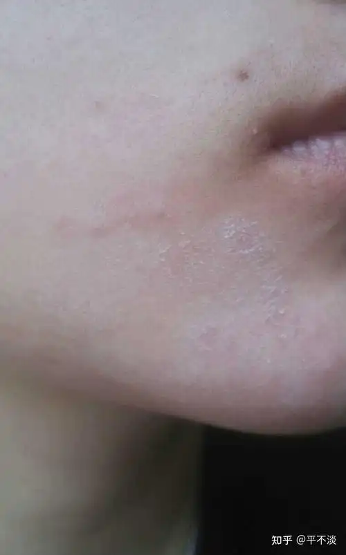 皮肤干燥瘙痒,起皮,掉白屑,烫伤皮肤红肿怎么办?隆力奇蛇油膏,蛇油棒