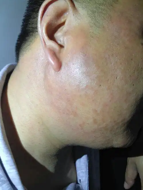 我爸爸脸部两侧有红色湿疹一样的东西,很痒,外界接触会有刺激感.