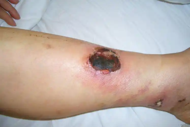 局部皮肤坏死,请指教