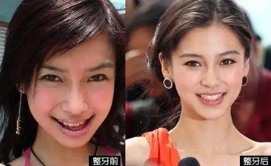 不但会让人变得更加的自信,微笑更加甜美迷人,所以明星整牙也更为普遍