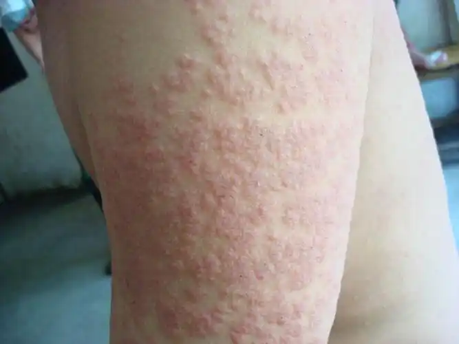 阴茎长毛囊炎的症状图片