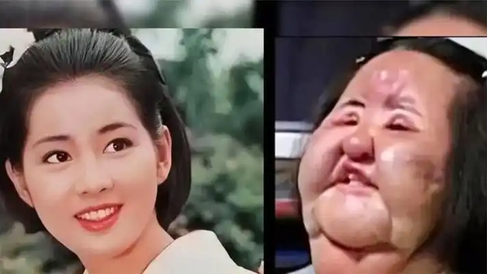 医美失败的明星们有多可怕,邵音音整容失败,关之琳难回巅峰