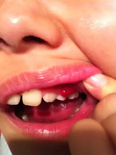 9岁男孩牙齿旁边长了小肉粒,并且牙齿有点 松动,这是什么情况,急