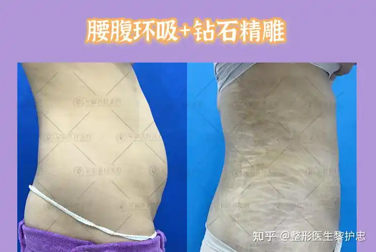 腰腹环吸联合钻石精雕案例分享