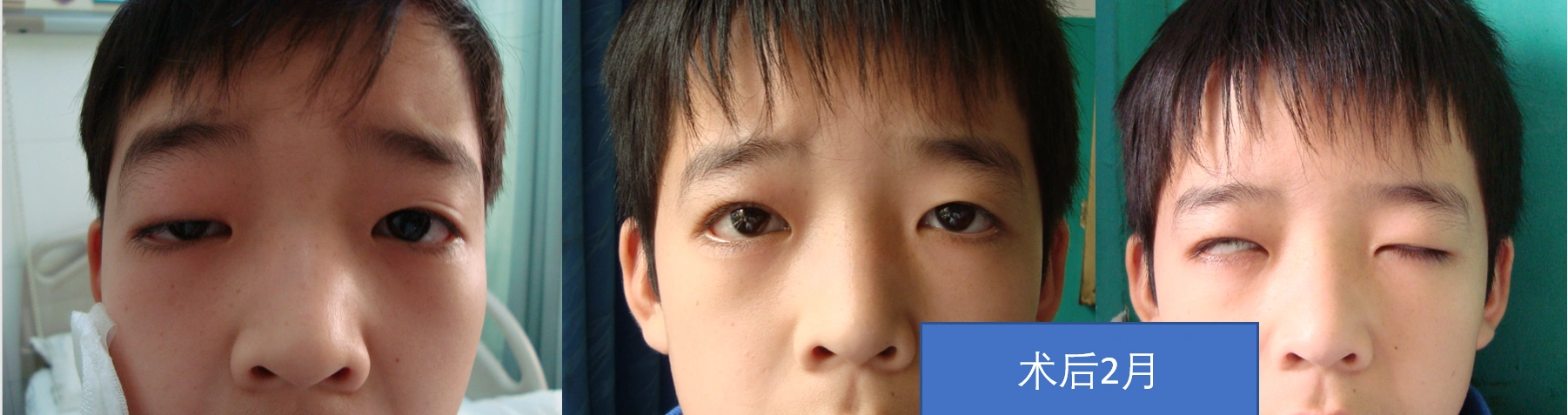 上睑下垂_手术_治疗方式 - 好大夫在线