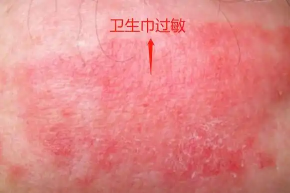 用卫生巾过敏的症状图