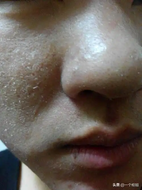 每次洗完脸都有白白的皮屑,脸还特别干燥紧绷是怎么回事?