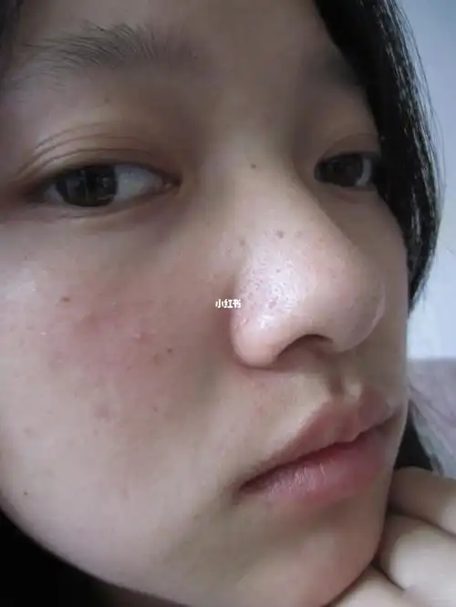 请问各位刘亦菲们毛孔粗大有黑头该怎么办