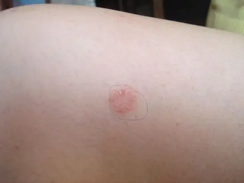 银屑病图片 - 皮肤及性传播疾病讨论版 - 爱爱医医学论坛