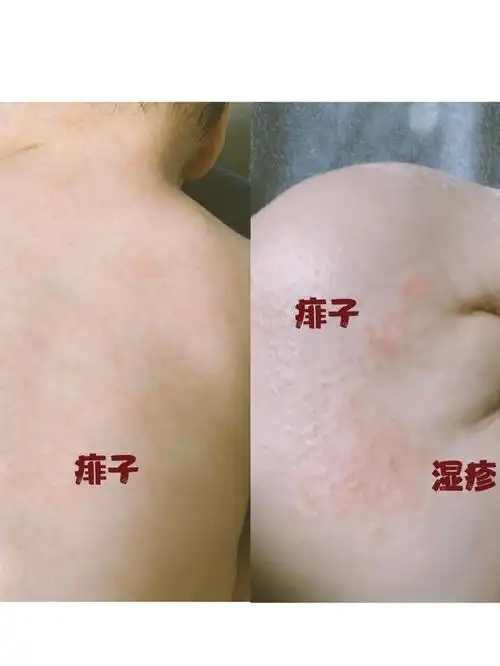 宝宝湿疹和热痱正确护理方法和步骤