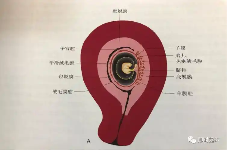 胎盘早剥的超声诊断