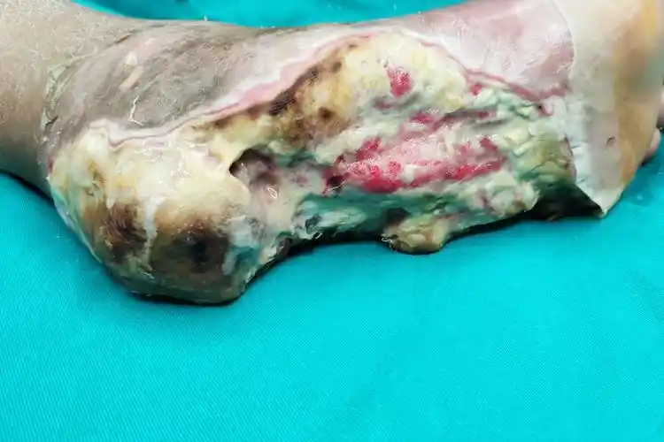 脚踝烂洞溃疡图片