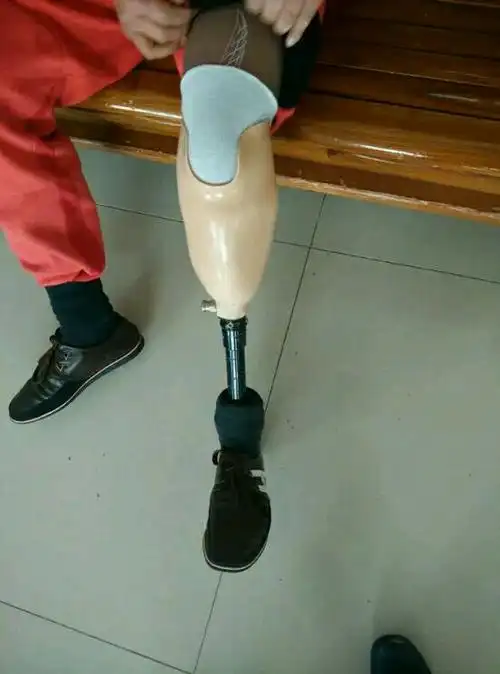 左小腿截肢装假肢后要适应多久