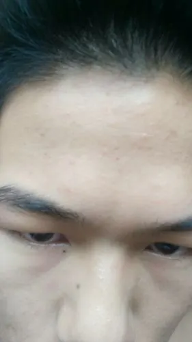 请问各位大神,我额头上这些是粉刺,还是小痘痘,还是黑头,不知道去黑头