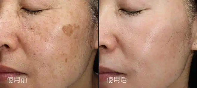 她们没有一夜"换脸",但却在一天一天的坚持中,成功祛斑;每天轻轻松松