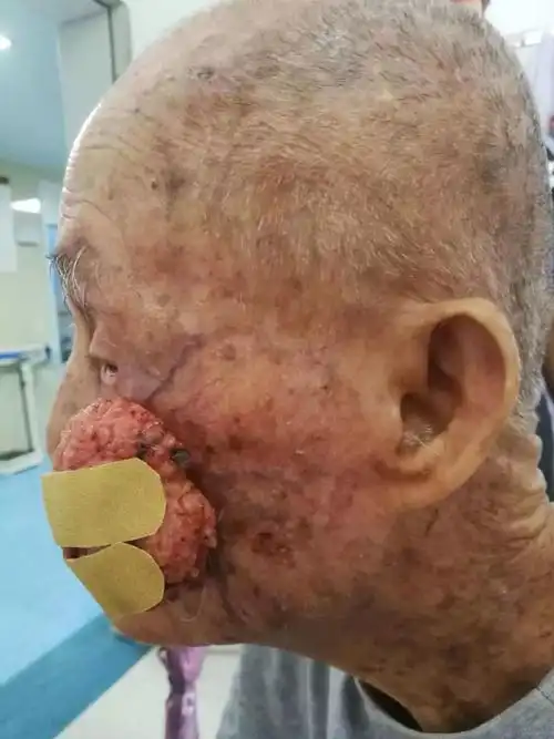 典型案例99岁老人脸部巨大肿物吓坏家人市中心人民医院