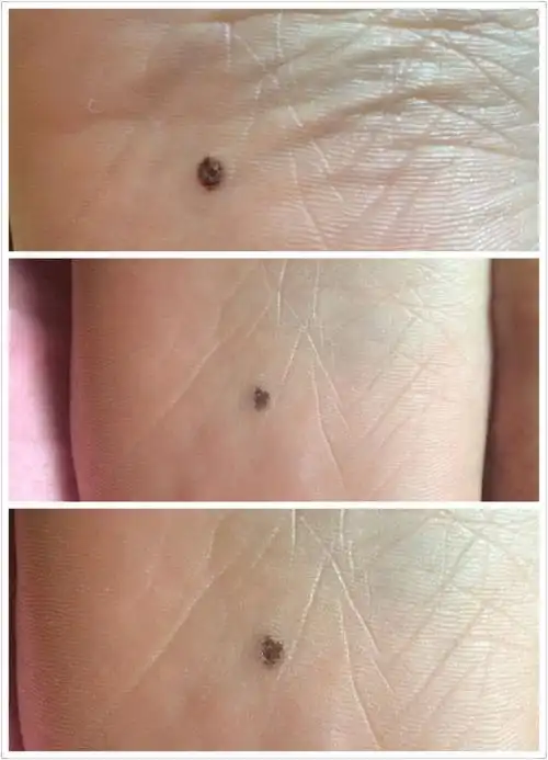我从小脚底就有一颗痣 但是到了18 19岁的时候 发现以前特别小不明显