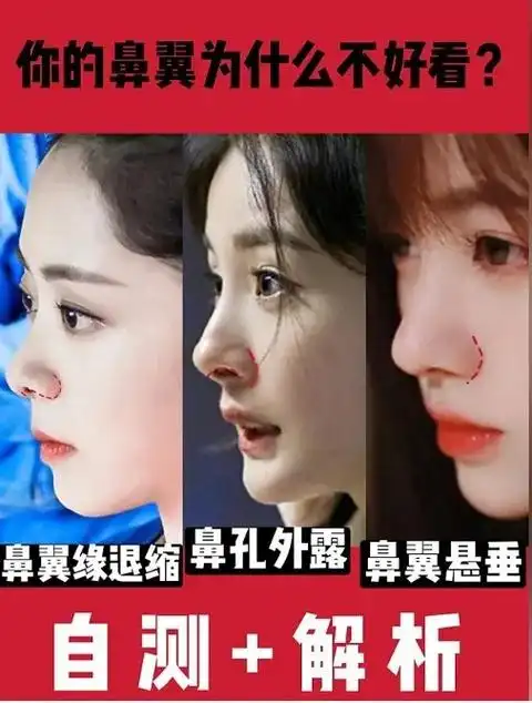 自测77解析.它鼻翼太丑怎么办? 好看的鼻子千 - 抖音