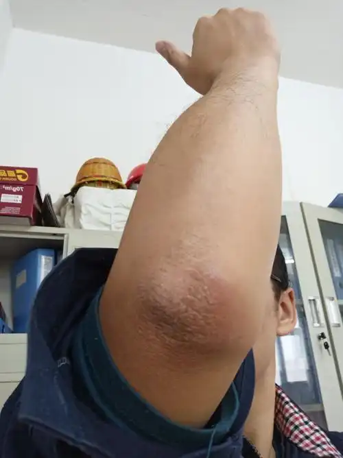 肘部皮肤粗糙,增厚,瘙痒,是真菌感染,还是什么问题?
