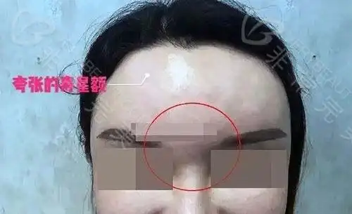 面部自体脂肪填充后很后悔?解析自体脂肪全脸填充利与弊!