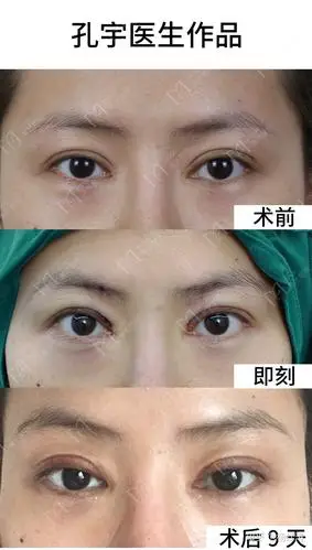 小切口修复后第九天虽然没有完全恢复,双眼皮的形状已基本成型了