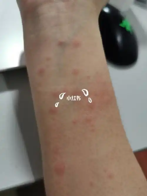 有点痒,特别是晚上朋友说是湿疹,但是之前没长过,也没对虾虾过敏呀,不