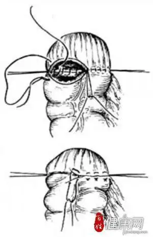 乙状结肠直肠切除端端吻合术