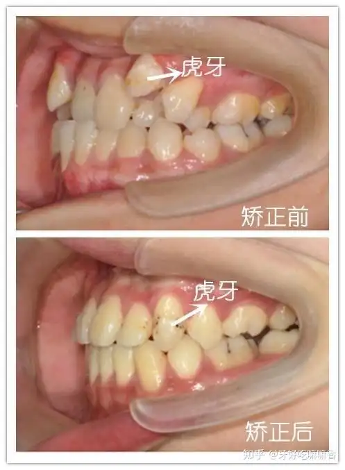 虎牙到底应不应该拔掉