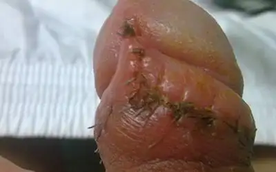 容易复发的疾病,做包皮环切术对于疾病的治疗以及预防有一定的帮助