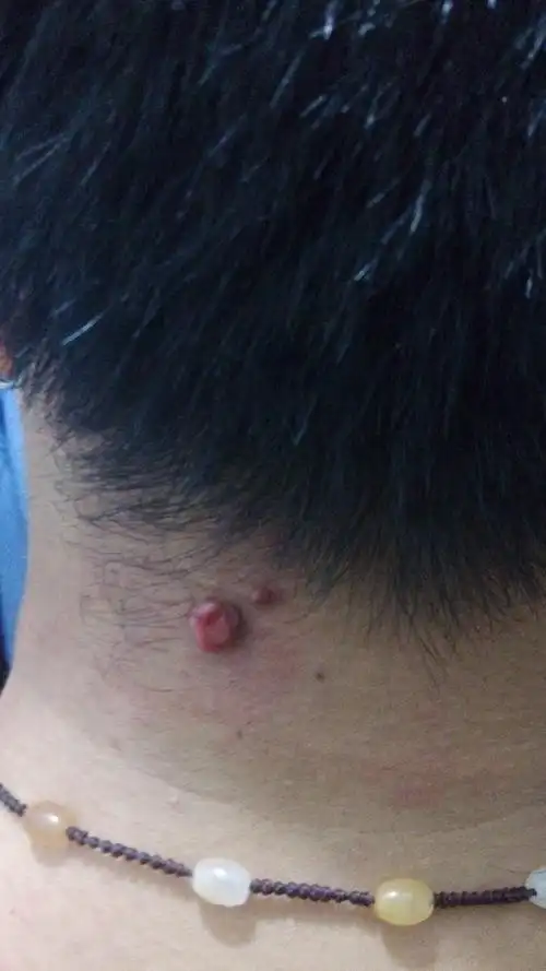 脖子后面长了一个黄豆大小的小肉球,平时不疼不痒,一弄破就不停